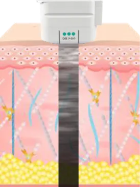 皮膚内部を確認しながら照射