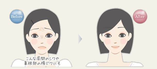 バニーライン　ボトックス注射の図
