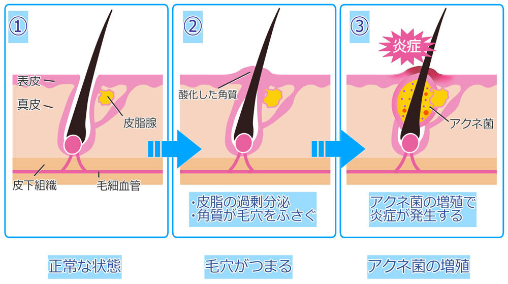 ニキビができるメカニズム